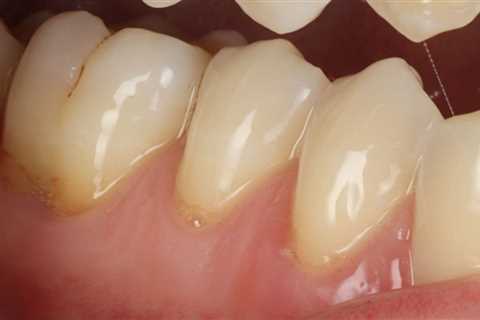 Loose Gum Flap Between Teeth - Receding Gums Treatment