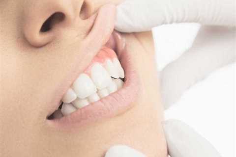 Stop Receding Gums Naturally - CASH CARE DOCTOR