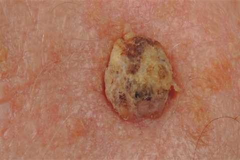 Diagnosing Squamous Cell Carcinoma: What You Need to Know
