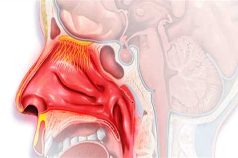 Kann eine nichtallergische Rhinitis Asthma verursachen?