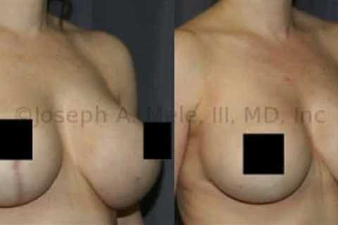 Breast Implant Maintenance and Breast Revision Surgery