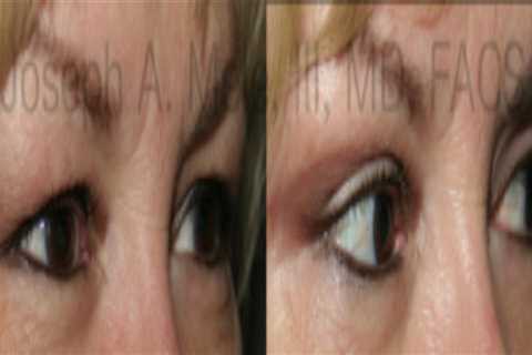 Eyelid Rejuvenation (Blepharoplasty)