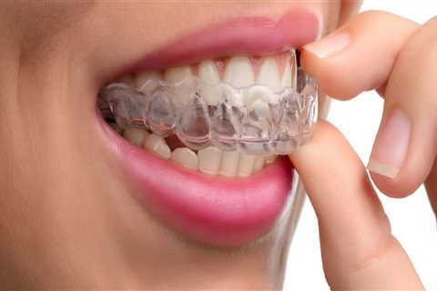 How Long Does it Take to Achieve a Perfect Smile with Invisalign?