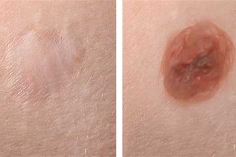 The Risks of Damage to Surrounding Tissue During Mole Removal