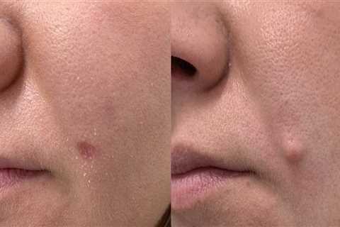 Pros and Cons of Laser Mole Removal Technique