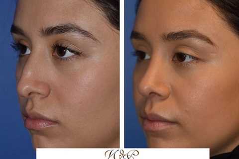 The Portland Center for Facial Plastic Surgery : Rhinoplasty, Facelift Surgery