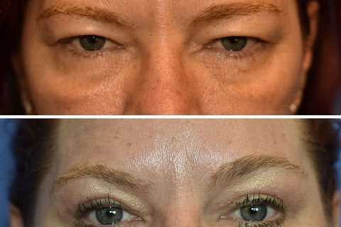 The Seattle Eyelid & Blepharoplasty Center