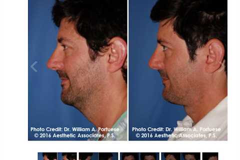 The Portland Center for Facial Plastic Surgery : Rhinoplasty, Facelift Surgery