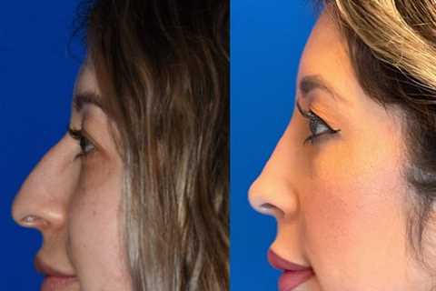 The Seattle Rhinoplasty Center