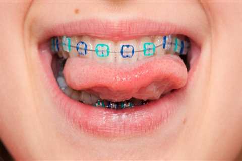 What Age is Best for Braces?