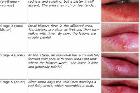Want To Know All About Cold Sores?