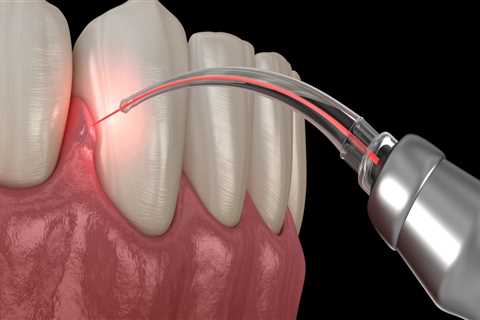 What is laser dental implant?