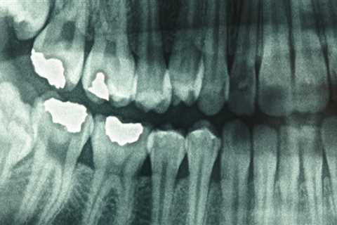 What is the side effect of dental x-ray?