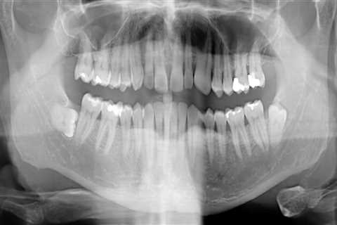 Do dental x rays cause cancer?