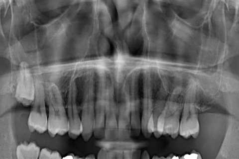 Can dental x rays show oral cancer?