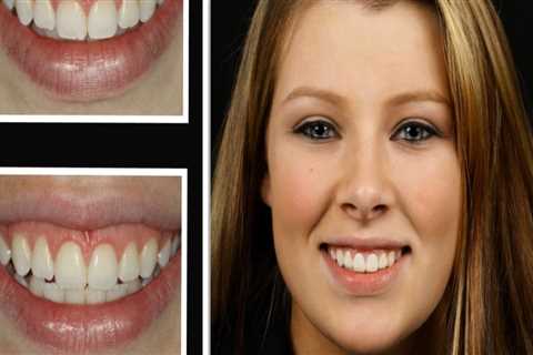 Is laser treatment good for gums?