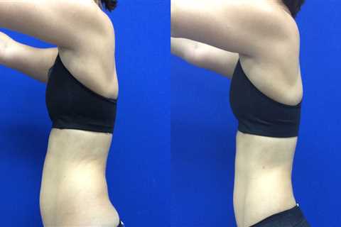 How do i get the best results after laser lipo?