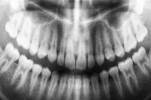 How toxic are dental x-rays?