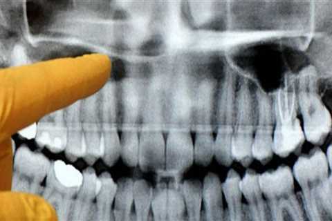 Can a dental panoramic x ray show cancer?