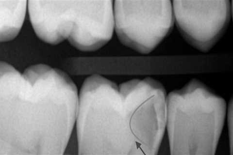 Can dental x rays be wrong?