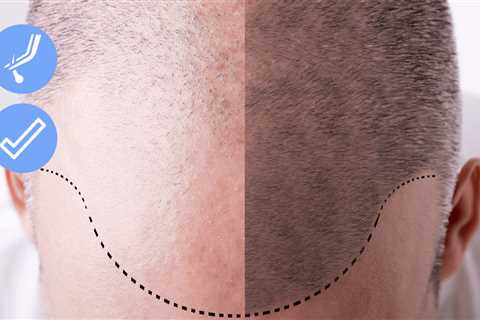 The Ultimate Guide To Hair Transplant In Indore