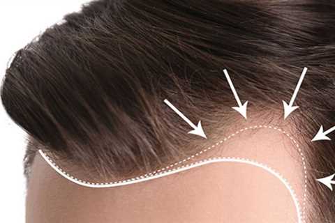 5 Easy Facts About Hair Transplant In Indore Described