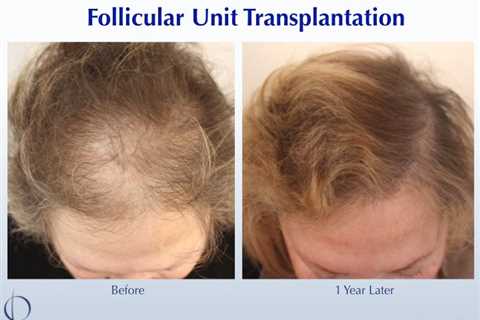 Unknown Facts About Hair Transplant In Indore