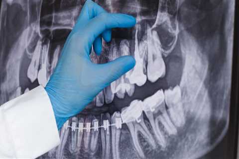 Do panoramic x-rays have more radiation?