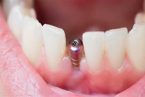 What You Need To Know About Getting Dental Implants In Spring Branch