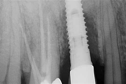 Can a failing implant be saved?