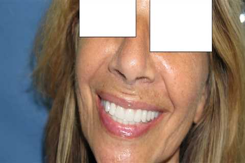 Can dental implants change face shape?