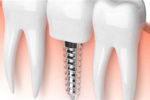 How dental implants are made?