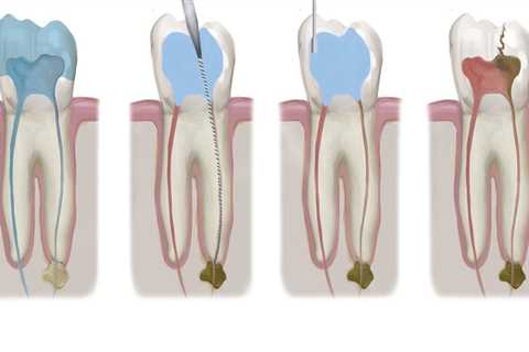 How Endodontic Treatment Saves the Tooth