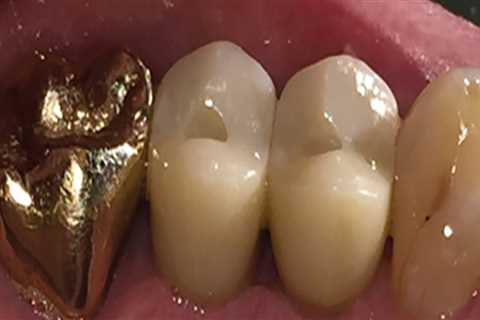 What to Avoid After Laser Dental Cleaning