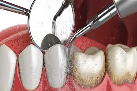 Revolutionize Your Oral Care Routine With Dental Laser Cleaning In Mansfield Texas