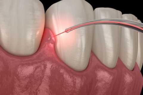 Is Laser Teeth Cleaning Safe and Effective?