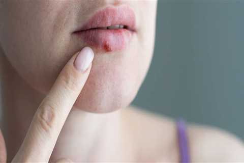 Pain Relievers: Exploring Treatment Options for In Mouth Herpes