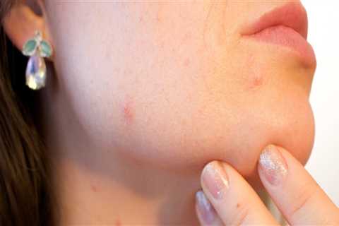 Exploring the Genetics Behind Acne