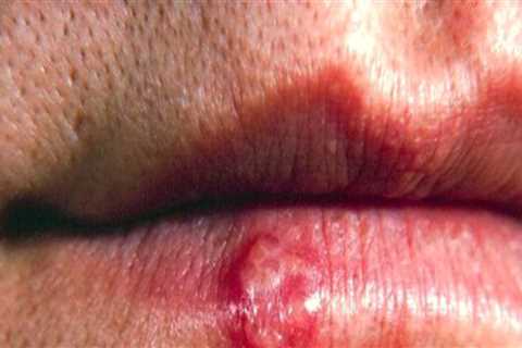 Herpes Simplex Virus Type 1 – Causes, Symptoms, Treatment