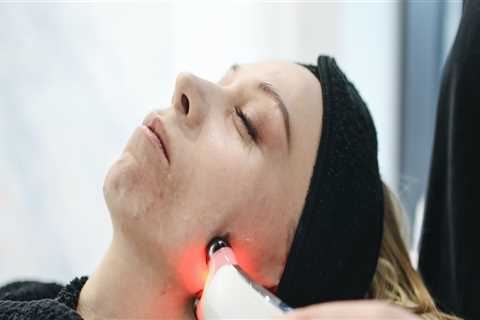 Laser Therapy for Acne Scars: A Comprehensive Overview