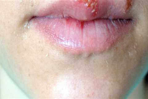 Preventing the Spread of Oral Herpes Infection