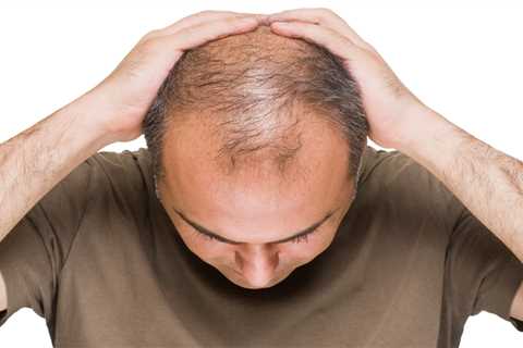 Hair Loss In Men: Understanding Male Pattern Baldness And Other Causes