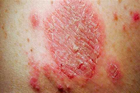 Understanding Itchy or Burning Rashes on the Skin