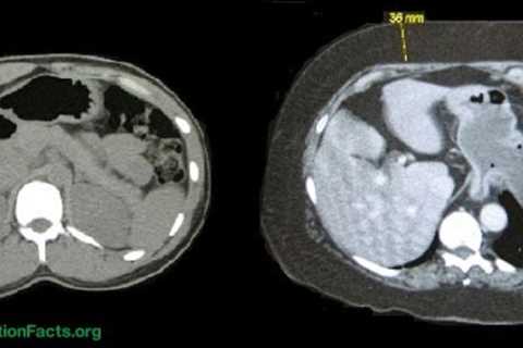 Metabolic Syndrome and Plant-Based Diets