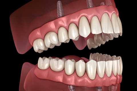 How to Whiten Denture Implants