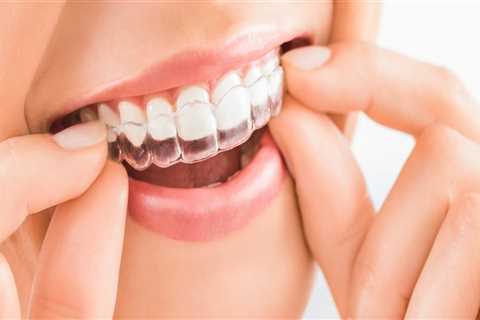 How Long Does It Take to Straighten Teeth with Invisalign Clear Braces?