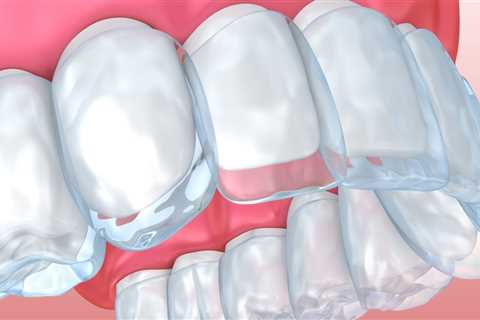 What to Do if You Experience Pain or Discomfort After Getting Invisalign Clear Braces