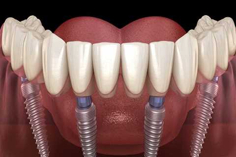 What Type of Anesthesia is Used for All-on-Four Dental Implants?