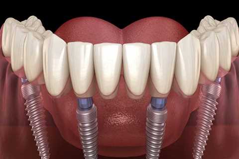 How Long Do All-on-Four Dentures Last?
