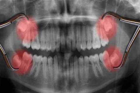 What Anesthesia Options Are Available for Wisdom Teeth Removal?
